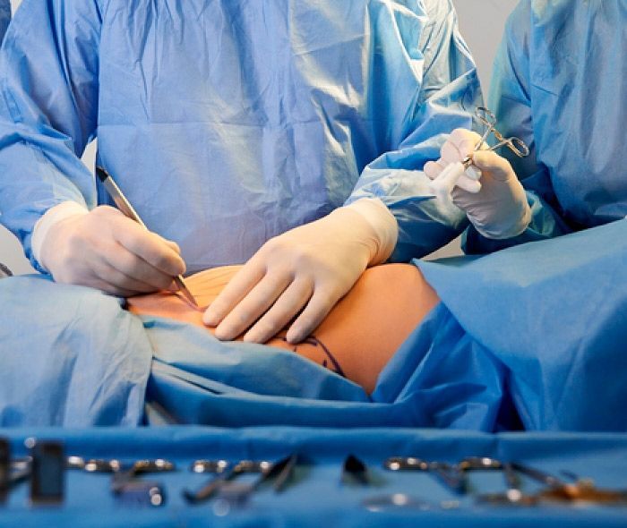 drferreyros_procedimiento-cuerpo-abdominoplastia-4
