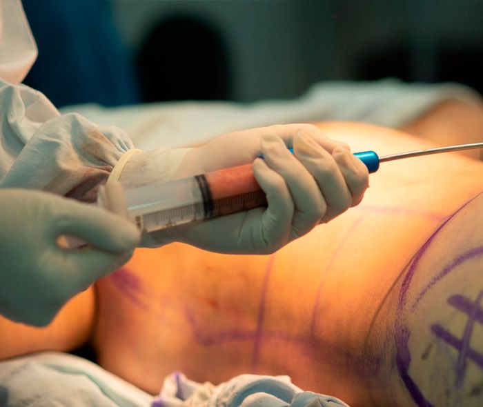 drferreyros_procedimiento-cuerpo-lipo-1