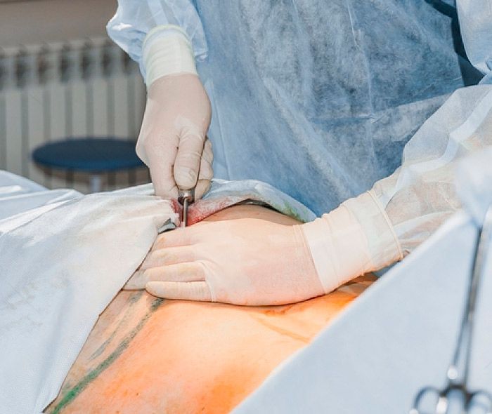 drferreyros_procedimiento-cuerpo-lipotrasferencia-1