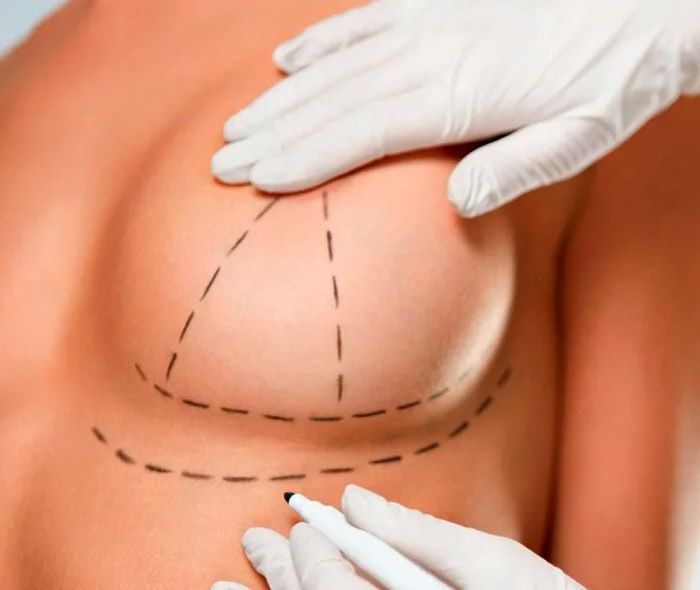 drferreyros_procedimiento-cuerpo-mastopexia-1