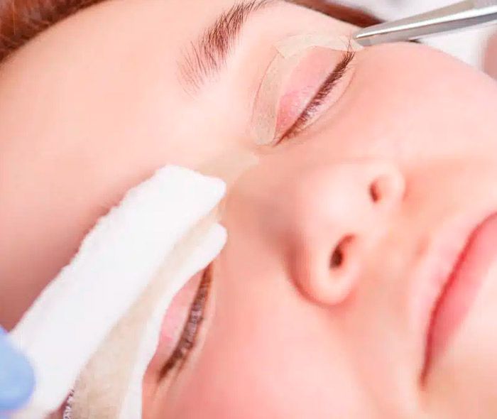 drferreyros_procedimiento-facial-blefaroplastia
