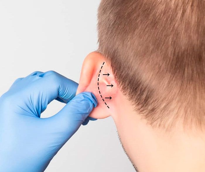 drferreyros_procedimiento-facial-otoplastia-1